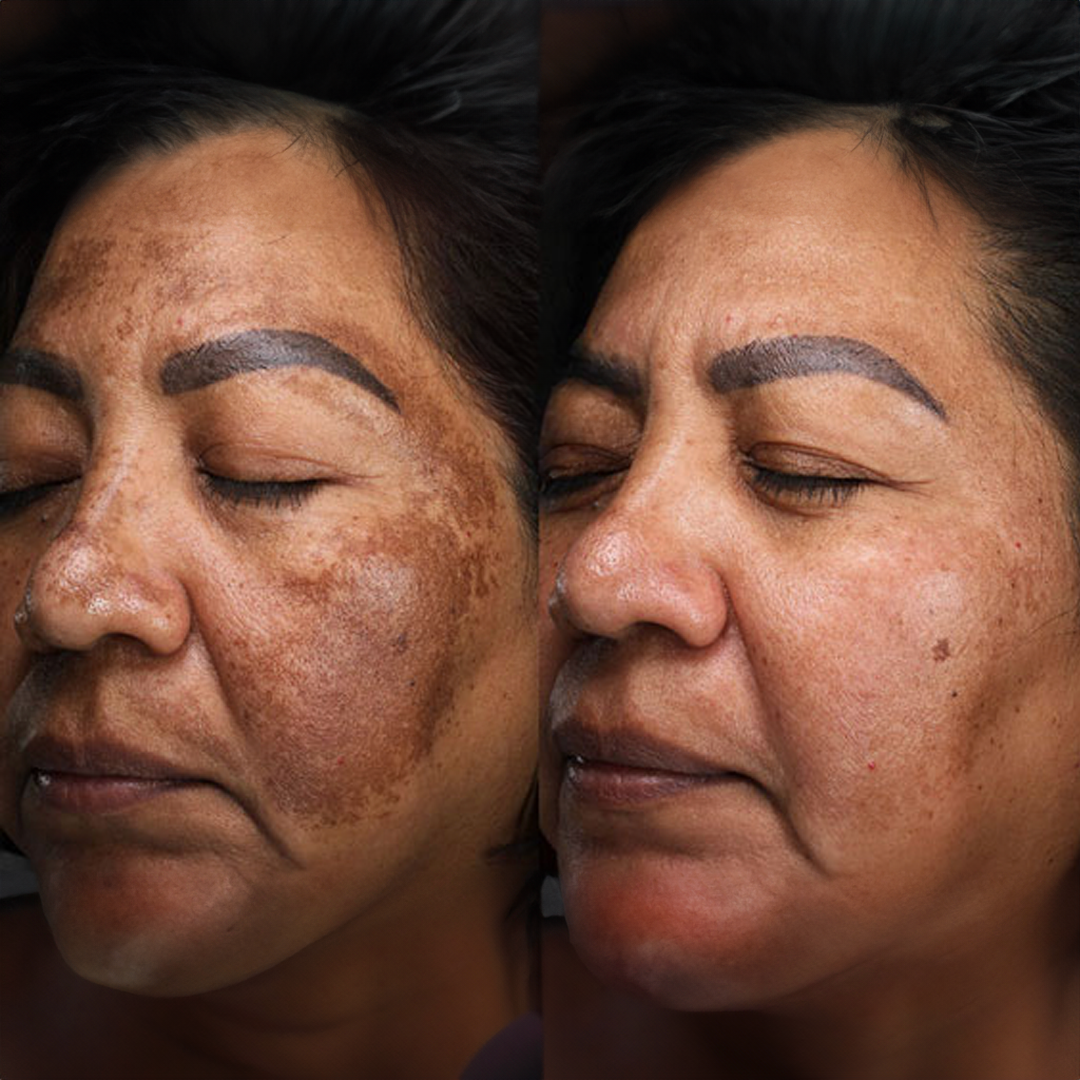 Hyperpigmentation